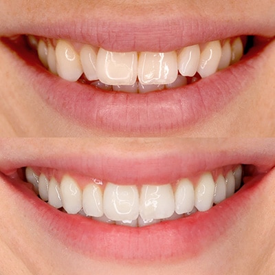 Smile Results