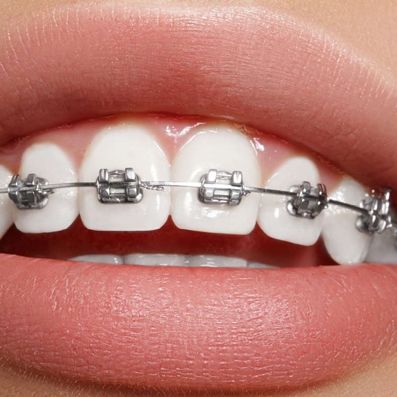 Metal Braces