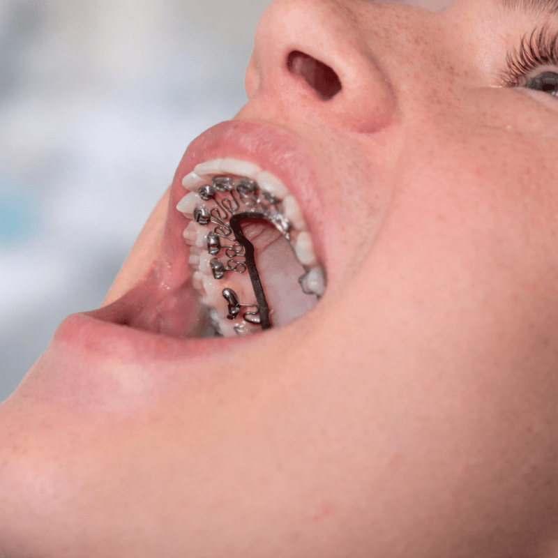 Braces Closeup