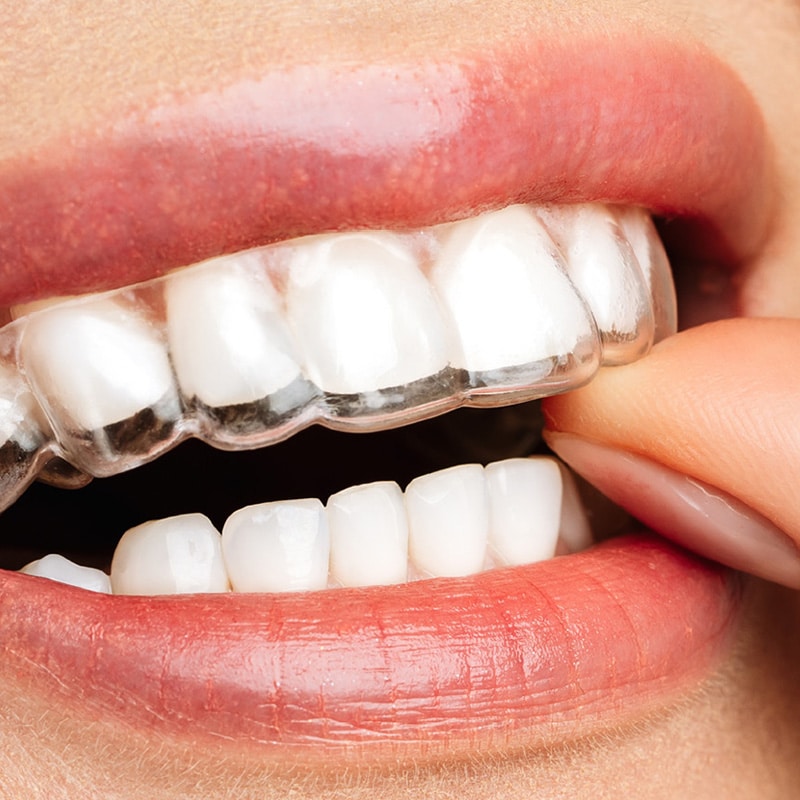Clear Aligners