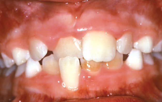 Front Crossbite