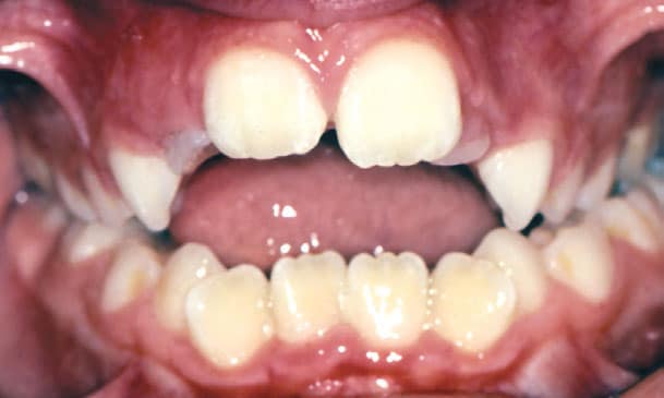 Open Bite