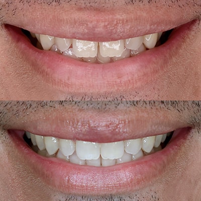 Smile Results