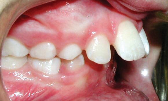 Tooth Protrusion